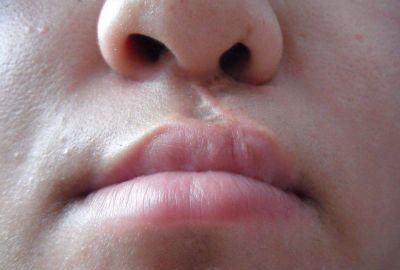 唇腭裂图片,先天性唇腭裂是什么原因导致的图6