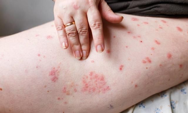 湿疹是什么症状,湿疹有什么症状